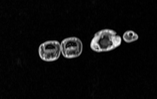  PANCREAS MRI T2 AXIAL IMAGES