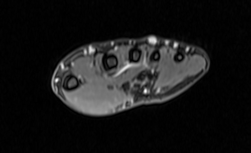  PANCREAS MRI T2 AXIAL IMAGES