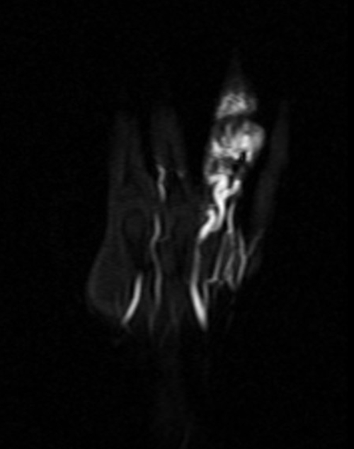  PANCREAS MRI T2 AXIAL IMAGES