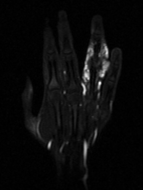  PANCREAS MRI T2 AXIAL IMAGES