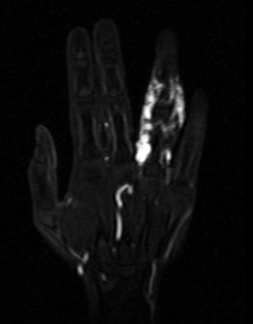  PANCREAS MRI T2 AXIAL IMAGES