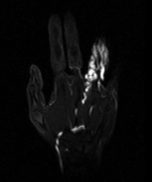  PANCREAS MRI T2 AXIAL IMAGES