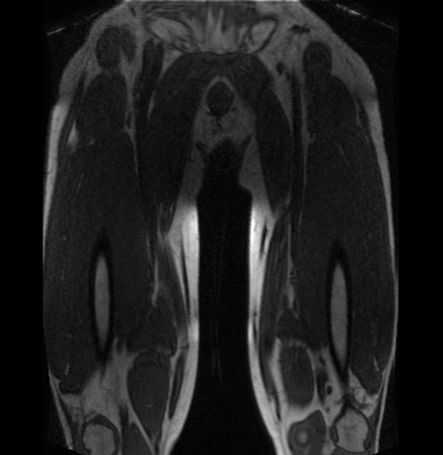 magnetic resonance angiography(MRA) whole body  t1 flash coronal 3d upper leg pre contrast  image