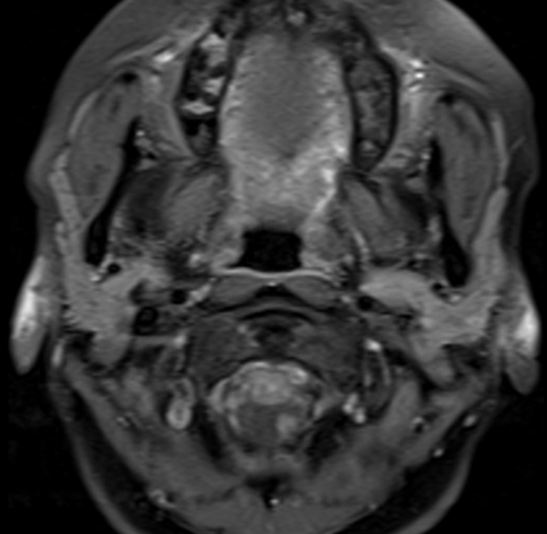 MRA neck t1 fat sat post contrast  images