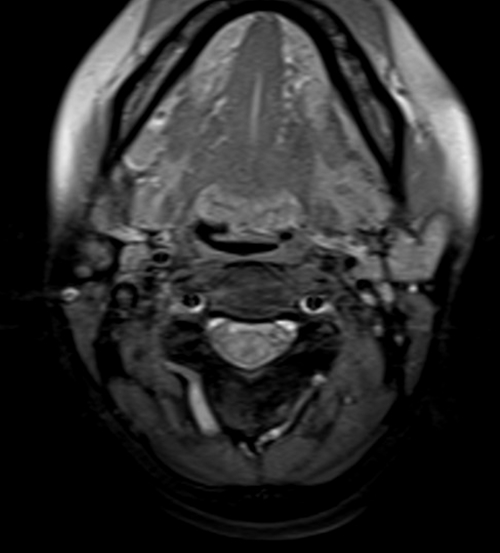 MRA neck t1 fat sat post contrast  images ,dissection protocol