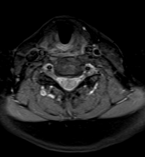 magnetic resonance angiography (MRA) neck t1 fat sat post contrast  images ,dissection protocol