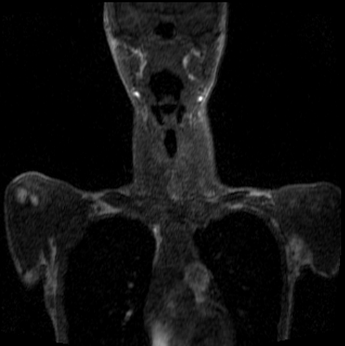 magnetic resonance angiography(MRA) whole body pre contrast chest and neck image