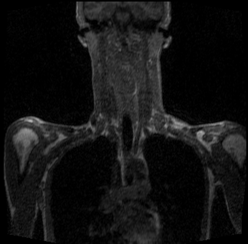 magnetic resonance angiography(MRA) whole body pre contrast chest and neck image