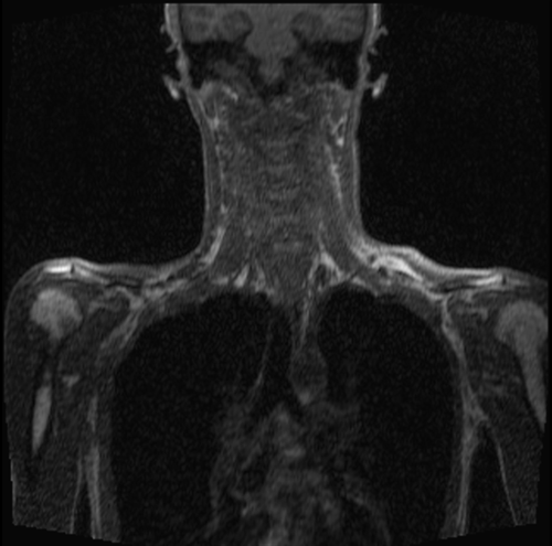 magnetic resonance angiography(MRA) whole body pre contrast chest and neck image