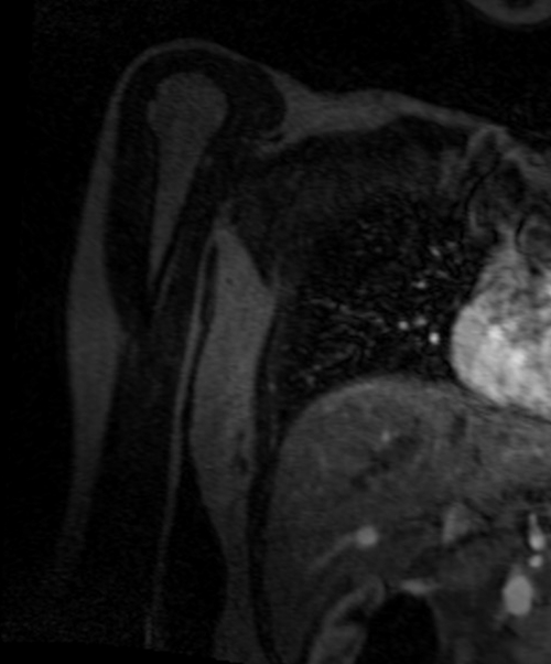 magnetic resonance angiography (MRA) upper arm ( humours )  T1 flash  coronal post contrast image (Axillary artery  angiography)