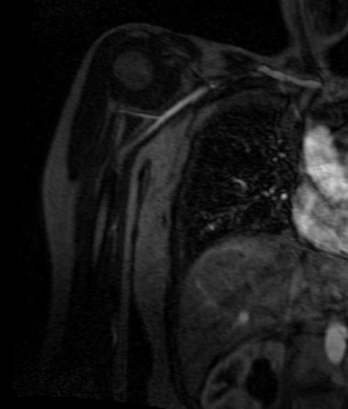 agnetic resonance angiography (MRA) upper arm ( humours )  T1 flash  coronal post contrast image (Axillary artery  angiography)