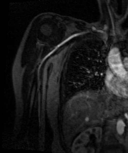 agnetic resonance angiography (MRA) upper arm ( humours )  T1 flash  coronal post contrast image (Axillary artery  angiography)