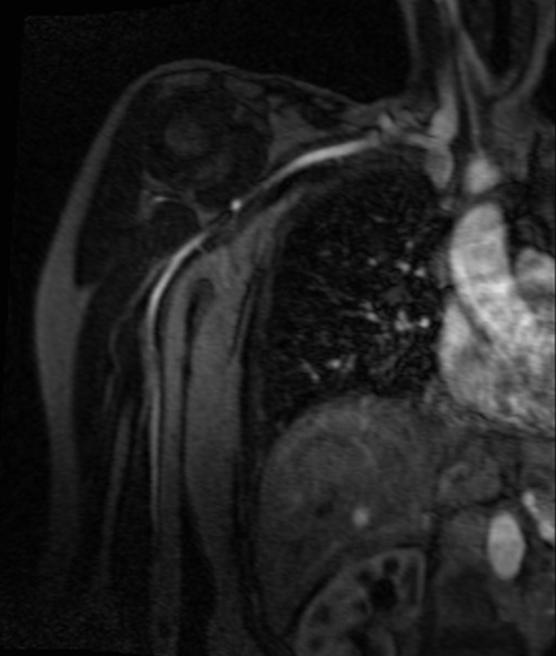 agnetic resonance angiography (MRA) upper arm ( humours )  T1 flash  coronal post contrast image (Axillary artery  angiography)