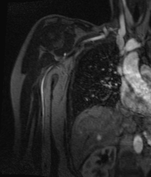 agnetic resonance angiography (MRA) upper arm ( humours )  T1 flash  coronal post contrast image (Axillary artery  angiography)