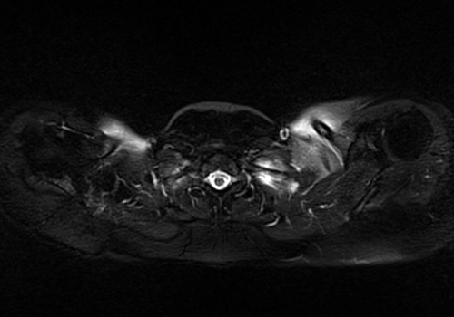 MRI chest axial stir image