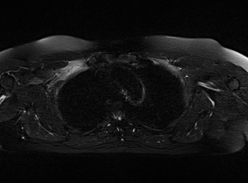 MRI chest axial stir image