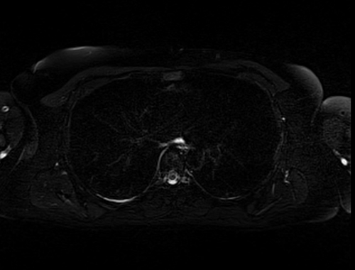 MRI chest axial stir image