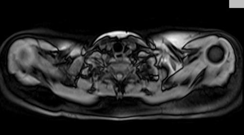 MRI chest axial t1 fat sat image