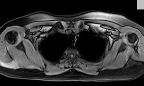 MRI chest axial t1 fat sat image