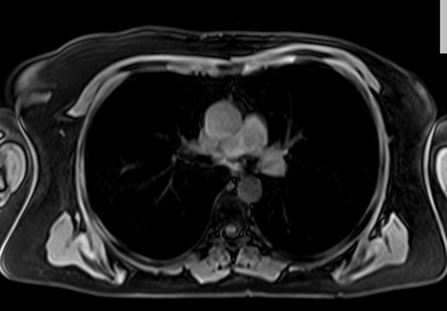 MRI chest axial t1 fat sat image