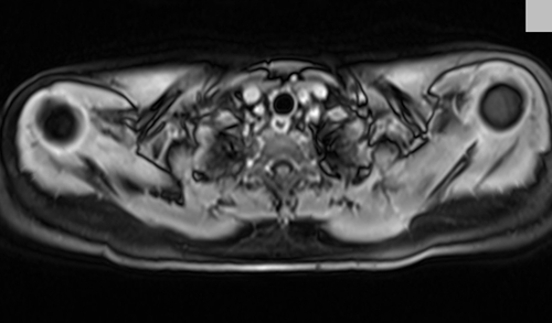 MRI chest axial t1 post contrast image 