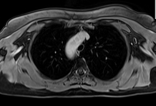 MRI chest axial t1 post contrast image 