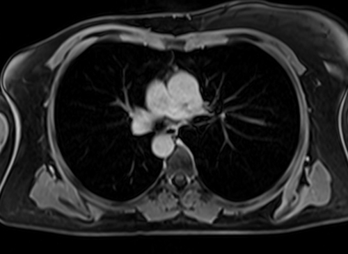 MRI chest axial t1 post contrast image 