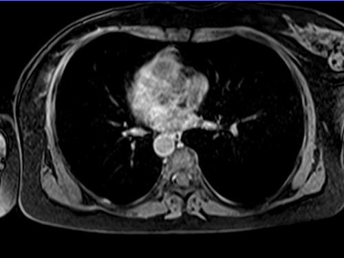 MRI chest axial t1 post contrast image 