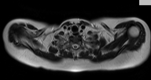 MRI chest axial t2 image