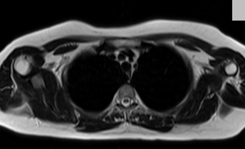 MRI chest axial t2 image