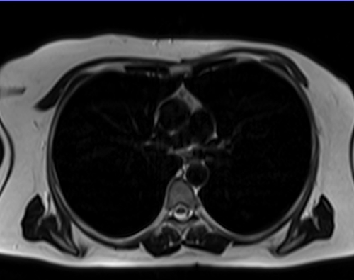 MRI chest axial t2 image