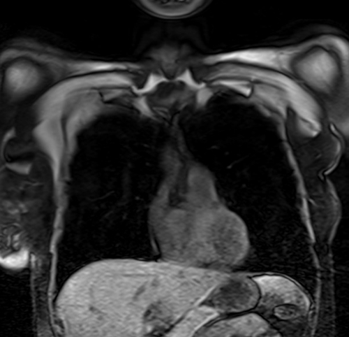 MRI chest coronal t1 image