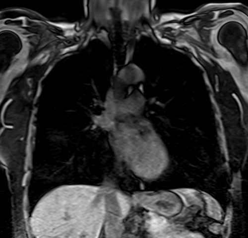 MRI chest coronal t1 image