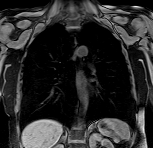 MRI chest coronal t1 image