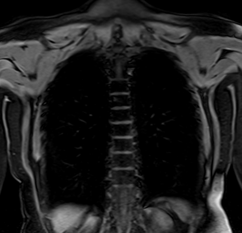 MRI chest coronal t1 image