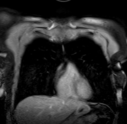 MRI chest coronal t1 post contrast image