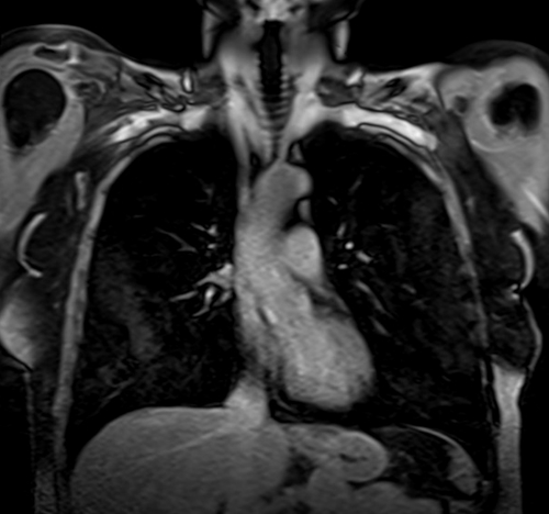 MRI chest coronal t1 post contrast image