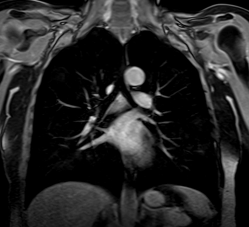 MRI chest coronal t1 post contrast image