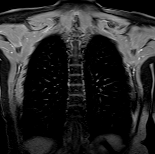 MRI chest coronal t1 post contrast image