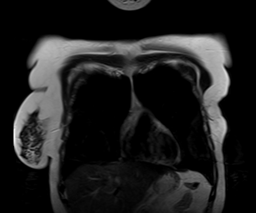 MRI chest coronal t2 image