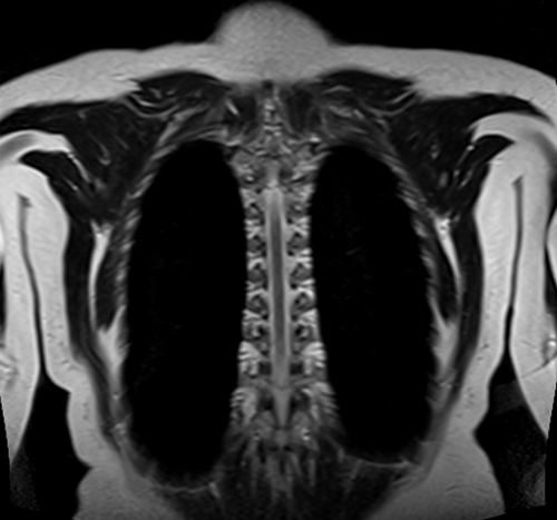 MRI chest coronal t2 image