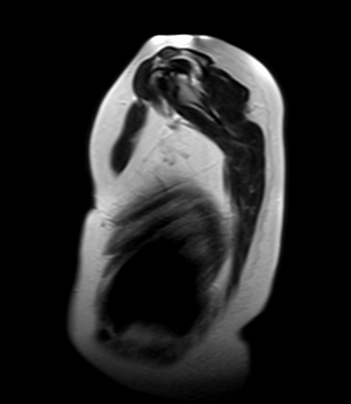 MRI chest sagittal t2 image