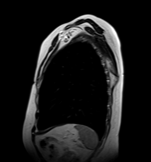 MRI chest sagittal t2 image