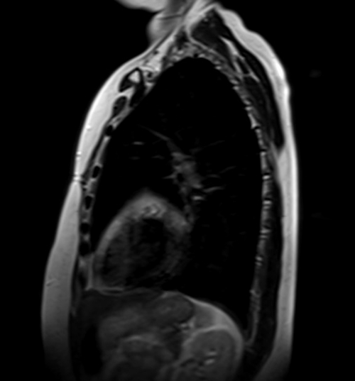 MRI chest sagittal t2 image