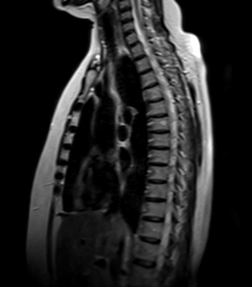 MRI chest sagittal t2 image