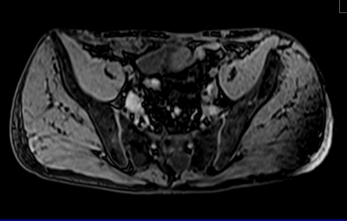 MRV abdomen axial t1 flash pre contrast  image