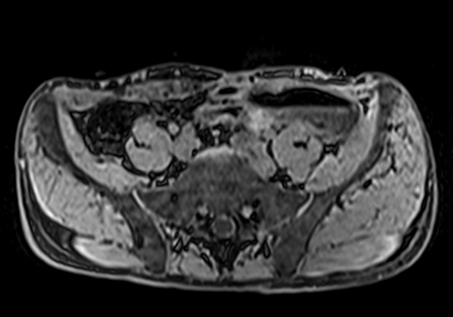 MRV abdomen axial t1 flash pre contrast  image 