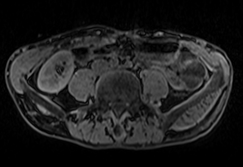 MRV and MRA abdomen axial t1 flash pre contrast  image 