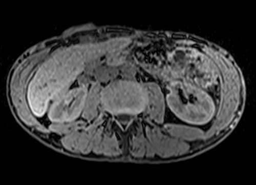 MRV and MRA abdomen axial t1 flash pre contrast  image 