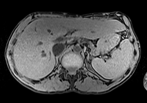 MRV abdomen axial t1 flash pre contrast  image 